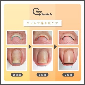 巻き爪でお困りの方必見!