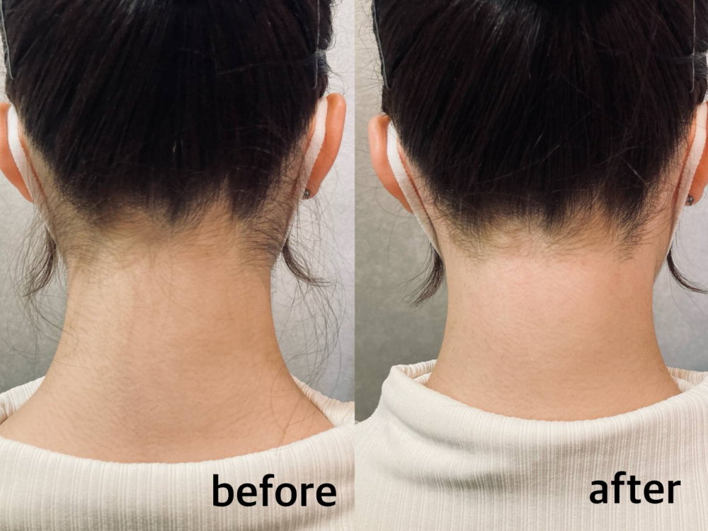 【うなじ脱毛】光とワックスのW脱毛でつるすべ美肌に!