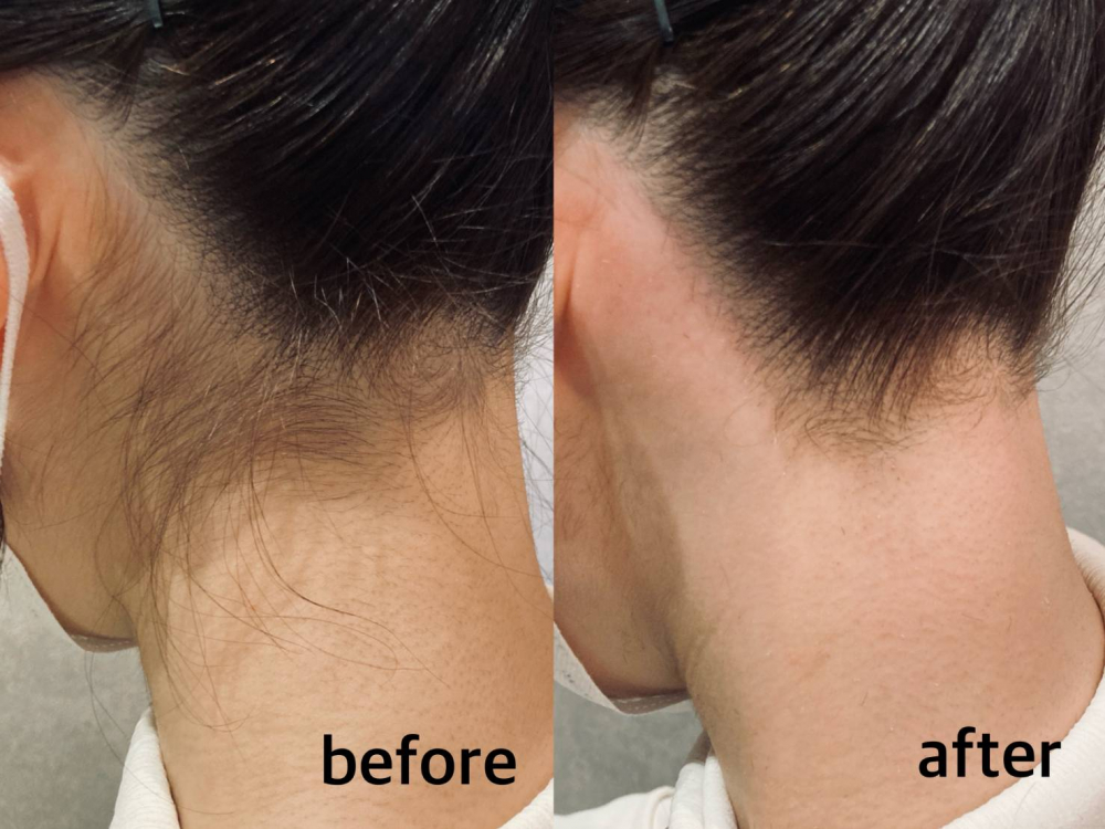 後ろ姿美人【襟足うなじ 光脱毛×ツヤ肌wax脱毛】W脱毛で毛穴レス美肌に